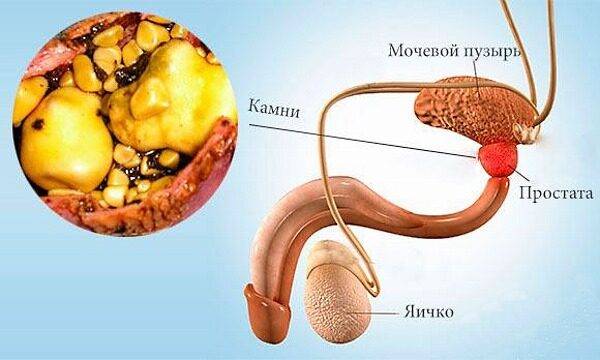 Кальцинаты в периуретральной зоне предстательной железы