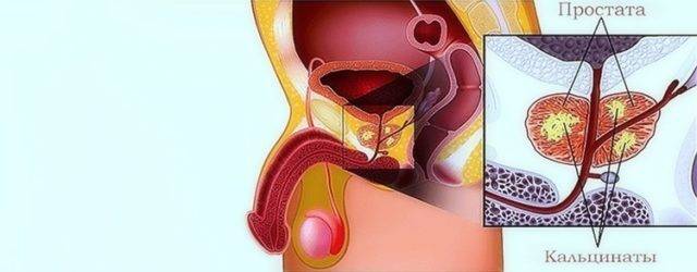 Кальцинаты в периуретральной зоне предстательной железы