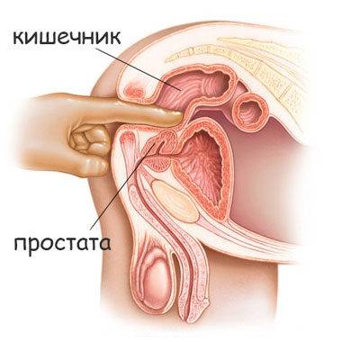 Кальцинаты в периуретральной зоне предстательной железы