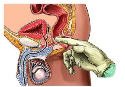 Пальцевой осмотр прямой кишки