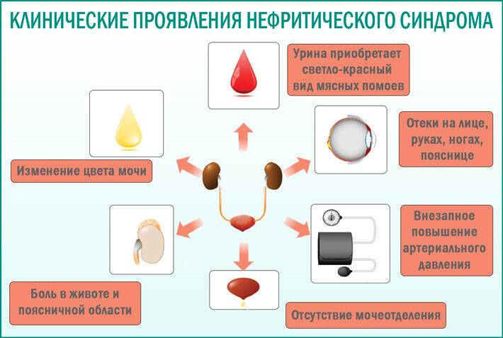 Нефритический синдром: клинические проявления