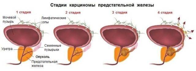 4 стадия рака простаты с метастазами