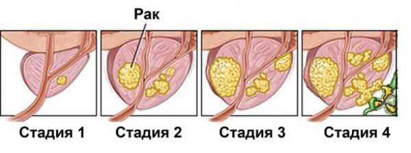 4 стадия рака простаты с метастазами