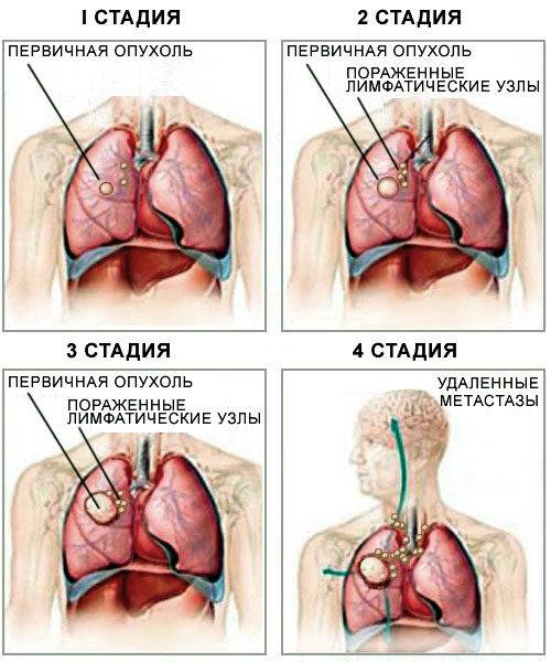 4 стадия рака простаты с метастазами