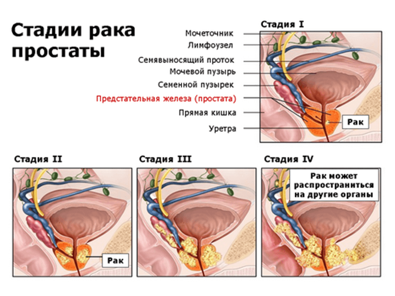 Мелкоацинарная карцинома предстательной железы