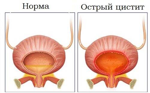 Как быстро проходит острый цистит