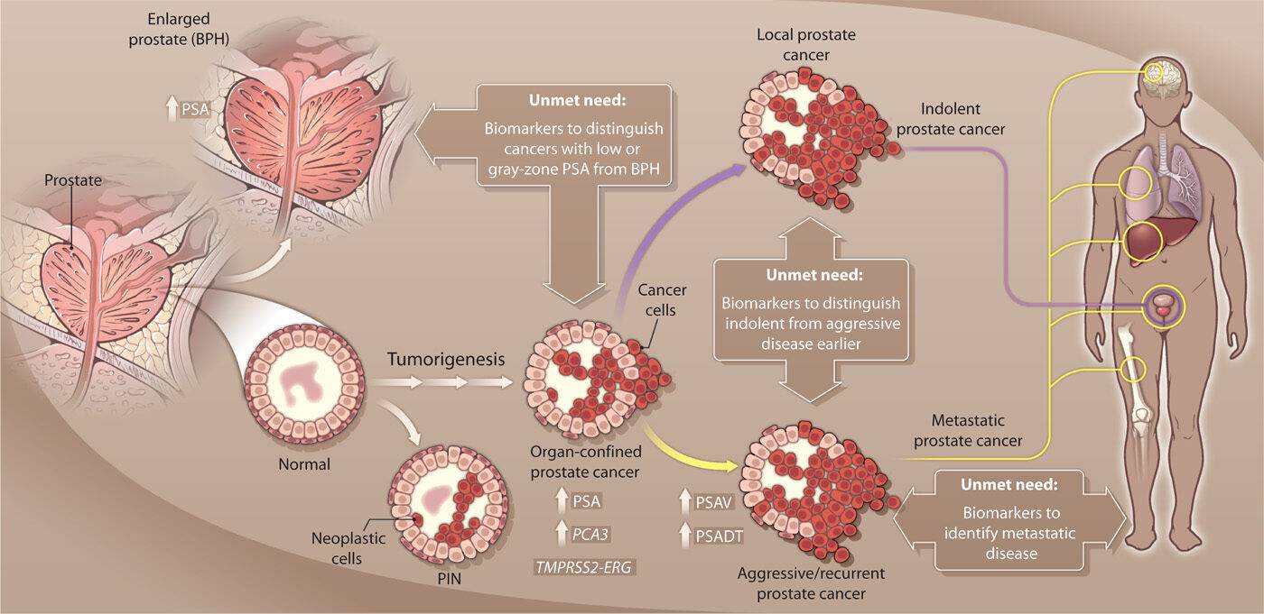 Нужны новые биомаркеры рака предстательной железы