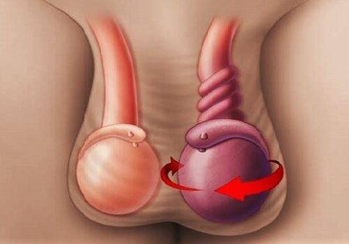 Перекрут гидатиды яичка или чем опасен недуг?