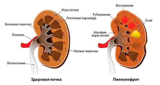 Пиелонефрит