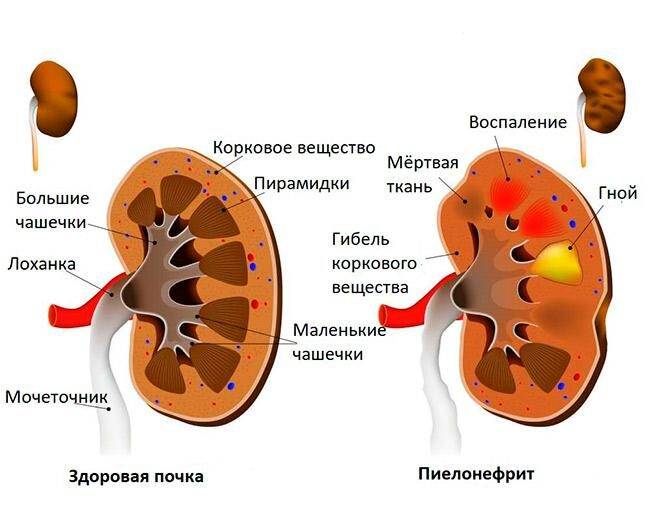 Пиелонефрит почек