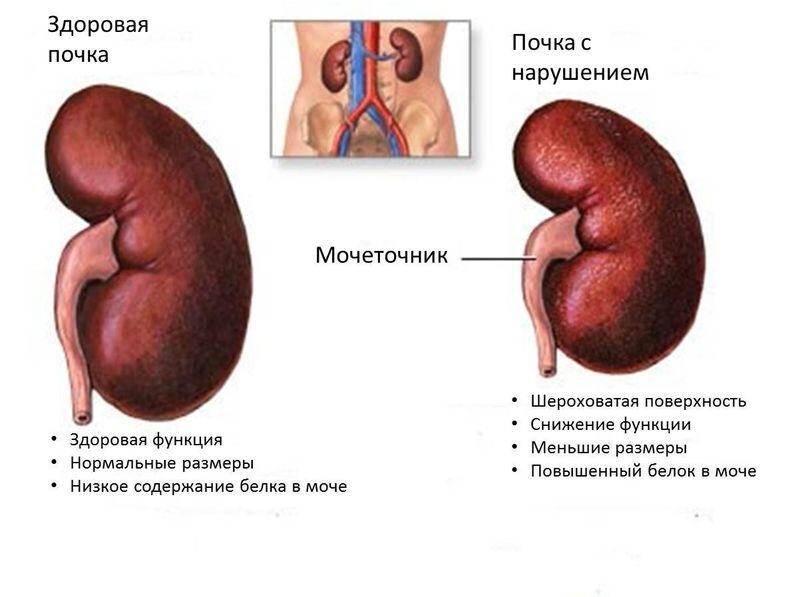 почка с нарушением