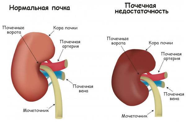 Почечная недостаточность