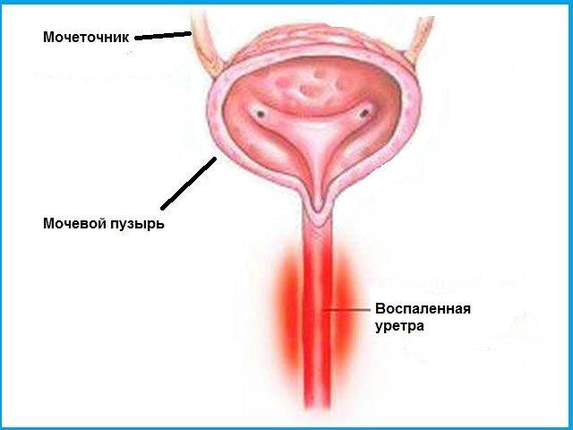 После мочеиспускания дискомфорт у мужчин — Prostatittut