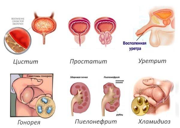 После мочеиспускания дискомфорт у мужчин — Prostatittut