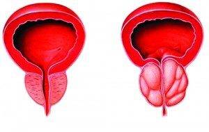 увеличенная простата
