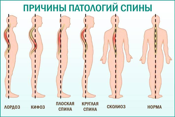 Боли в спине и пояснице: причины