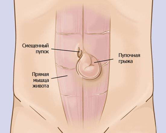 Пупочная грыжа у мужчины что делать