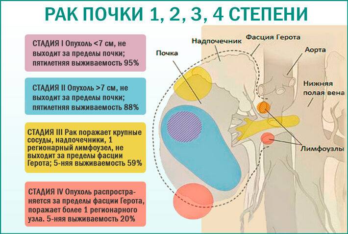 Рак почки 1, 2, 3, 4 степени: симптомы