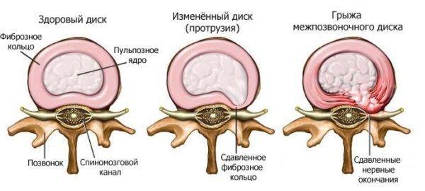 Развитие межпозвоночной грыжи