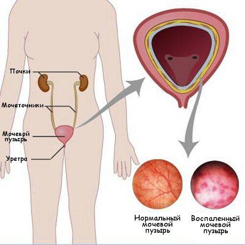 Цистит у мужчин симптомы и лечение, лекарства