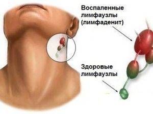 Вид воспаленных лимфоузлов