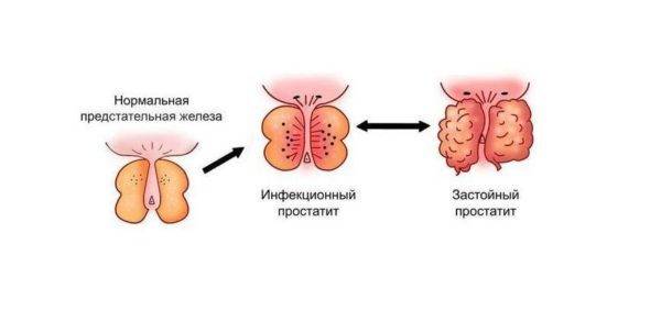 Виды простатита