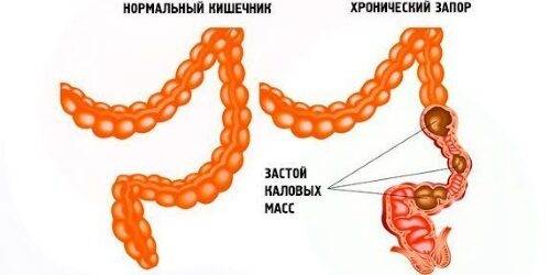 Почему мочевой пузырь не полностью опорожняется у женщин