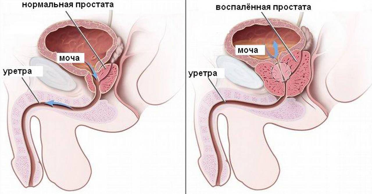 Лечение предстательной железы у мужчин. Симптомы воспаления предстательной железы и лечение