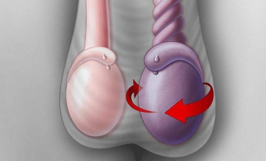 Увеличение размеров яичек из-за перекрута семенного канатика