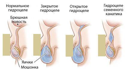 Причины водянки яичка у взрослого мужчины