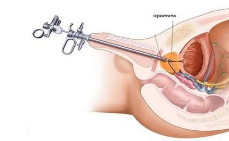 Биопсия простаты: показания, виды, способ проведения