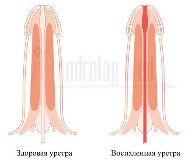 Почему моча с кровью у мужчин: причины, диагностика, лечение гематурии