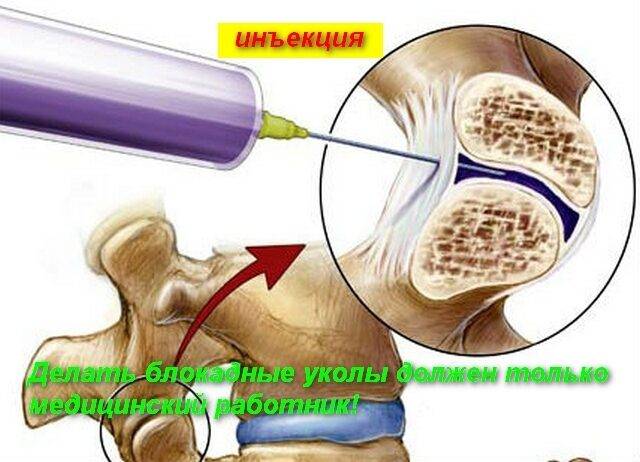 Укол блокада от боли