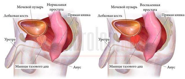 Почему моча с кровью у мужчин: причины, диагностика, лечение гематурии