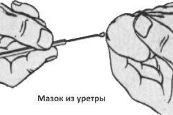 enterococcus faecalis у мужчин: норма, причины, симптомы и лечение