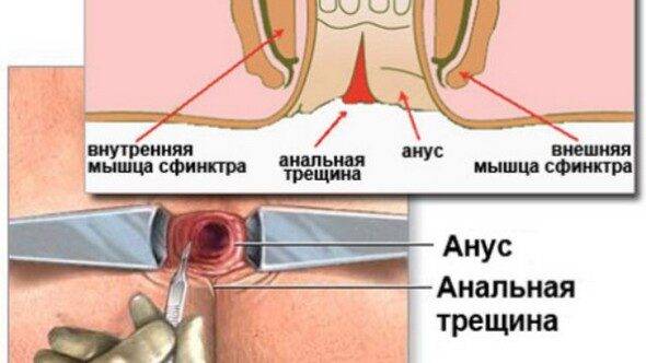 Анальная трещина