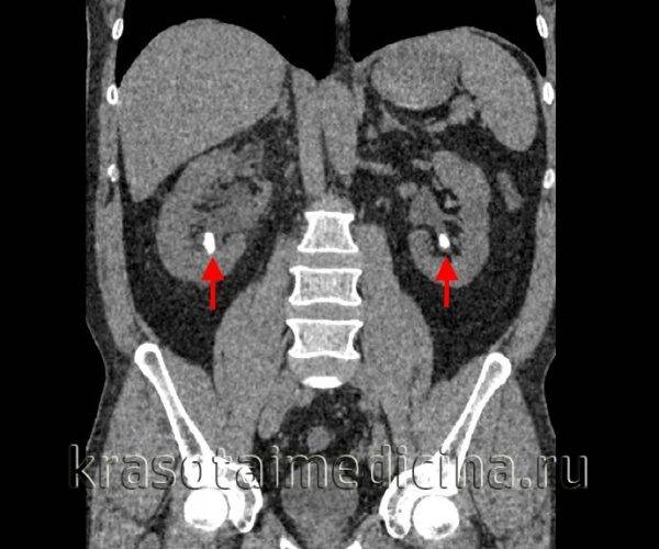КТ ОБП и забрюшинного пространства. Плотные конкременты в нижних чашечках с обеих сторон. (фото Вишняков В.Н.)