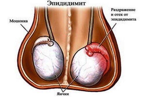Боль в яичках у мужчин: причины мужских болезней яичек