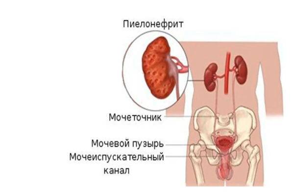 Лечение почек: чем лечить у мужчин и женщин, как вылечить народными средствами