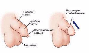 Фимоз у мальчиков, фото до и после лечения, а также что это за заболевание и как его лечить у детей, что делать с болезнью у ребенка?