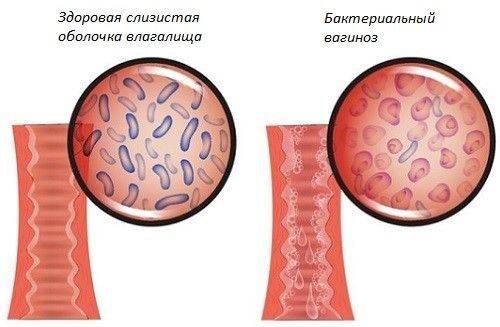 Вагиноз