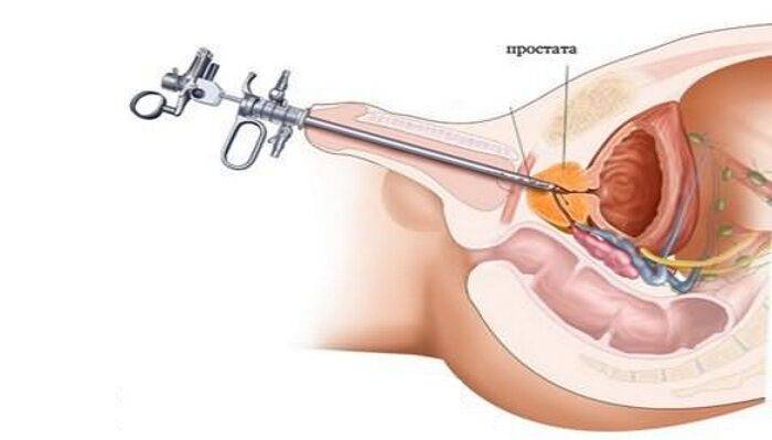 Биопсия простаты
