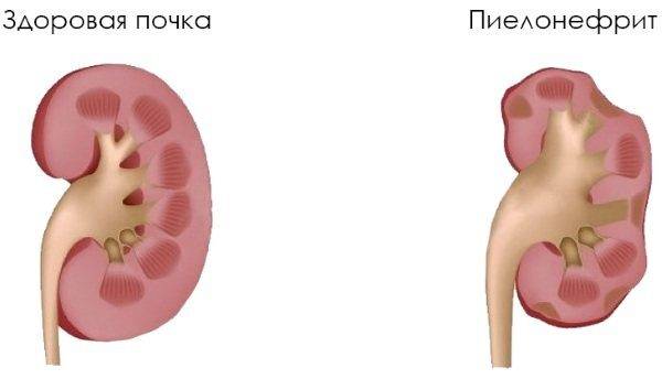 Боль паху у женщин слева, отдающая в бедро, ногу. Что это, ноющая, тупая, резкая, пульсирующая, колющая