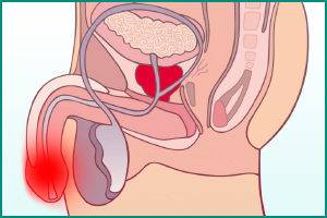 Боль в головке члена при мочеиспускании