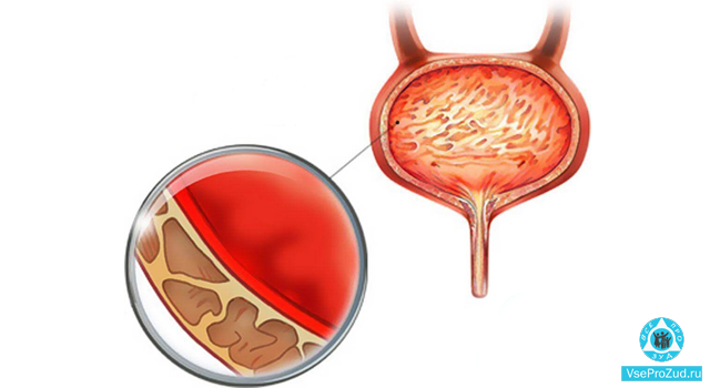 Мочевой пузырь