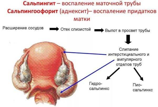 Воспаления по-женски придатков, почек, яичников, мочевого пузыря, лимфоузлов в паху, симптомы и лечение