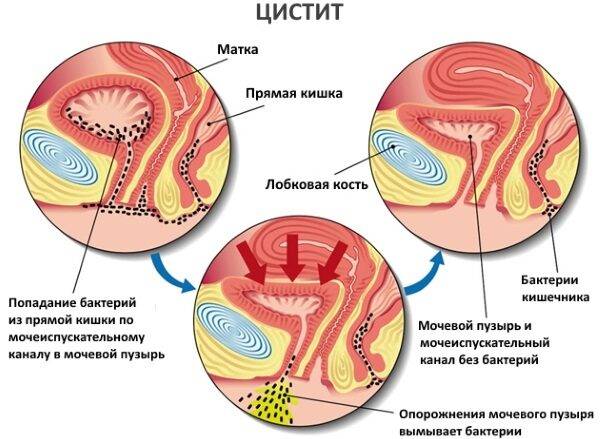 Болезненное мочеиспускание у женщин частое, в конце, с кровью. Причины и лечение