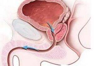 Затрудненное мочеиспускание у мужчин - причины и лечение