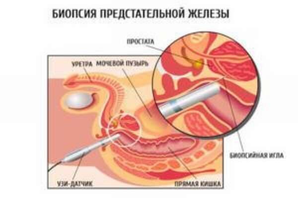 Биопсия предстательной железы, как проводится процедура биопсии простаты мужчинам, расшифровка результатов анализа