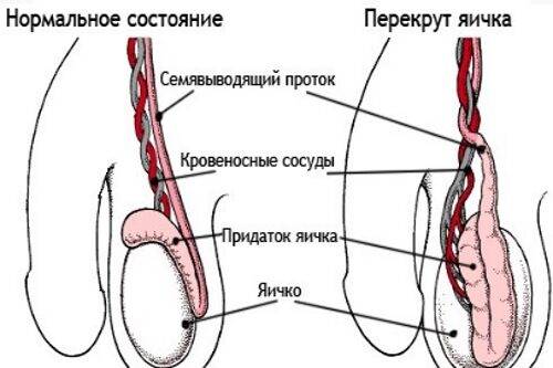 Боль в яичках у мужчин: причины мужских болезней яичек